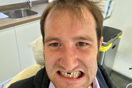 Before Invisalign Treatment Smile Rooms Glasgow Before Invisalign Treatment Smile Rooms Glasgow