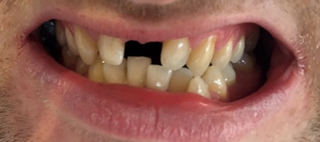 Before Invisalign Treatment Smile Rooms Glasgow Before Invisalign Treatment Smile Rooms Glasgow