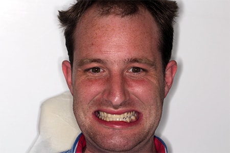 After Invisalign Treatment Smile Rooms Glasgow After Invisalign Treatment Smile Rooms Glasgow