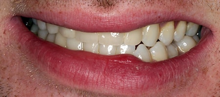 After Invisalign Treatment Smile Rooms Glasgow After Invisalign Treatment Smile Rooms Glasgow