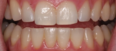 After Invisalign Treatment Smile Rooms Glasgow After Invisalign Treatment Smile Rooms Glasgow