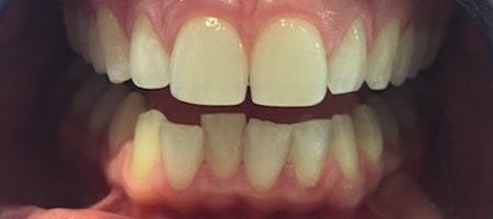 Before Invisalign Treatment Smile Rooms Glasgow Before Invisalign Treatment Smile Rooms Glasgow