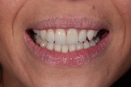 After Smile Makeover Treatment Smile Rooms Glasgow After Smile Makeover Treatment Smile Rooms Glasgow
