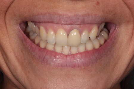 Before Smile Makeover Treatment Smile Rooms Glasgow Before Smile Makeover Treatment Smile Rooms Glasgow