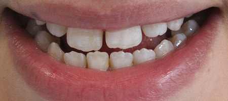 Before Invisalign Treatment Smile Rooms Glasgow Before Invisalign Treatment Smile Rooms Glasgow