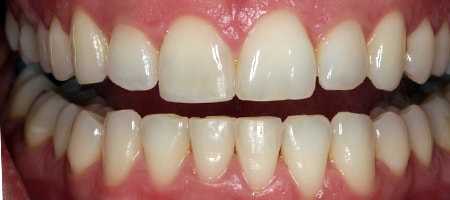 After Invisalign Treatment Smile Rooms Glasgow After Invisalign Treatment Smile Rooms Glasgow