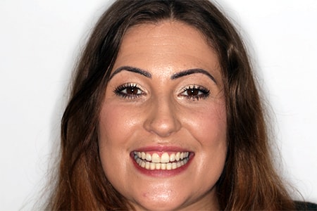 After Invisalign Treatment Smile Rooms Glasgow After Invisalign Treatment Smile Rooms Glasgow