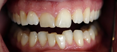 Before Invisalign Treatment Smile Rooms Glasgow Before Invisalign Treatment Smile Rooms Glasgow