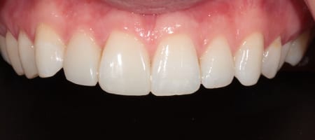 After Invisalign Treatment Smile Rooms Glasgow