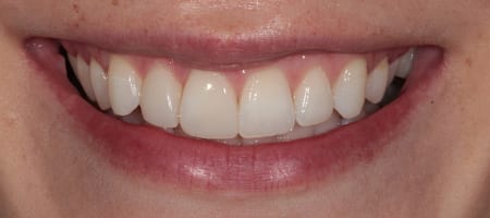After Invisalign Treatment Smile Rooms Glasgow