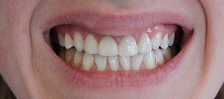 After Veneers Treatment Smile Rooms Glasgow After Veneers Treatment Smile Rooms Glasgow