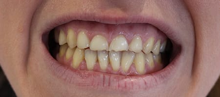 Before veneers Treatment Smile Rooms Glasgow Before veneers Treatment Smile Rooms Glasgow