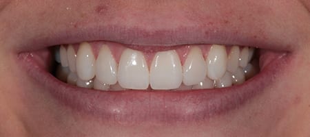 After Invisalign Treatment Smile Rooms Glasgow